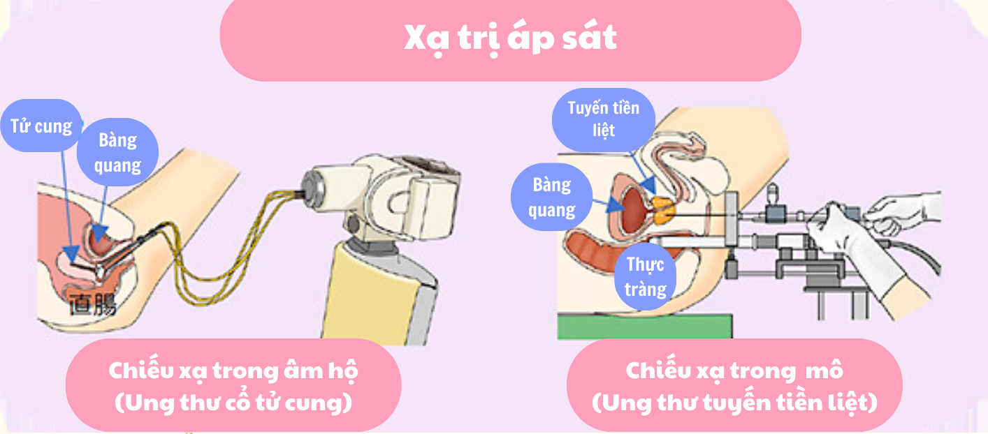 Xạ trị áp sát